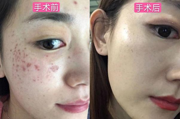 皮秒祛斑的費(fèi)用一般是多少 皮秒祛斑的危害與效果 皮秒祛斑的費(fèi)用一般是多少 皮秒祛斑的危害與效果