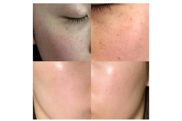 皮秒祛斑后期要怎樣護(hù)理 皮秒祛斑反黑多久能恢復(fù)正常 皮秒祛斑后期要怎樣護(hù)理 皮秒祛斑反黑多久能恢復(fù)正常