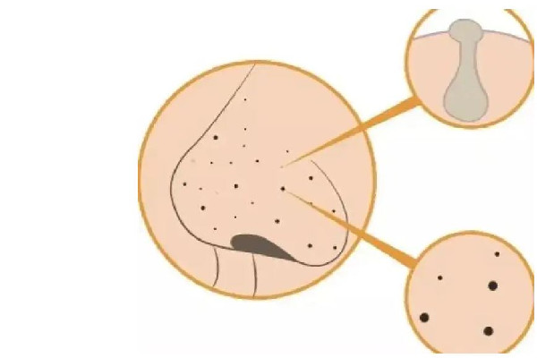 去黑頭產(chǎn)品排行榜10強(qiáng) 去黑頭收縮毛孔最好的方法 去黑頭產(chǎn)品排行榜10強(qiáng) 去黑頭收縮毛孔最好的方法