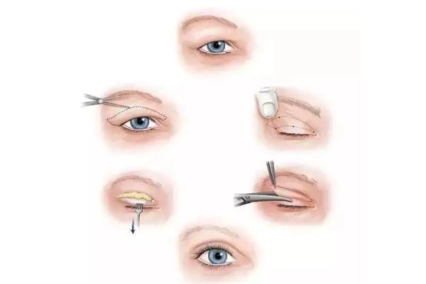 開眼角會(huì)顯老嗎 開眼角對(duì)眼睛有危害嗎 開眼角會(huì)顯老嗎 開眼角對(duì)眼睛有危害嗎