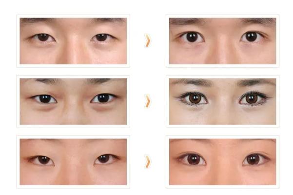 開眼角的恢復期是多久 開眼角要多久才能恢復正常 開眼角的恢復期是多久 開眼角要多久才能恢復正常