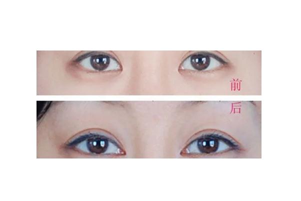 開眼角有必要嗎 開眼角會(huì)長回去嗎
