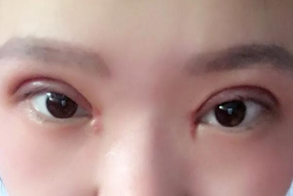 開眼角的恢復期是多久 開眼角要多久才能恢復正常 開眼角的恢復期是多久 開眼角要多久才能恢復正常