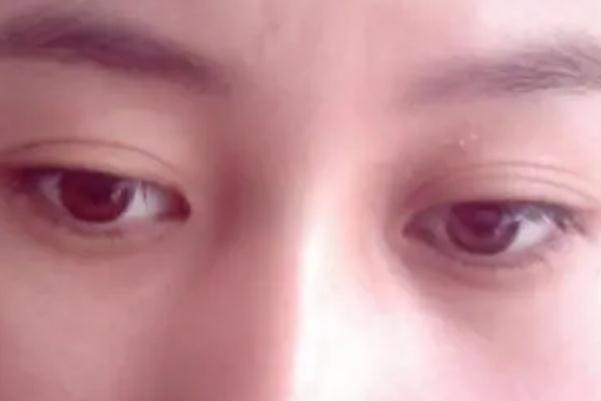 開眼角會(huì)顯老嗎 開眼角對(duì)眼睛有危害嗎 開眼角會(huì)顯老嗎 開眼角對(duì)眼睛有危害嗎