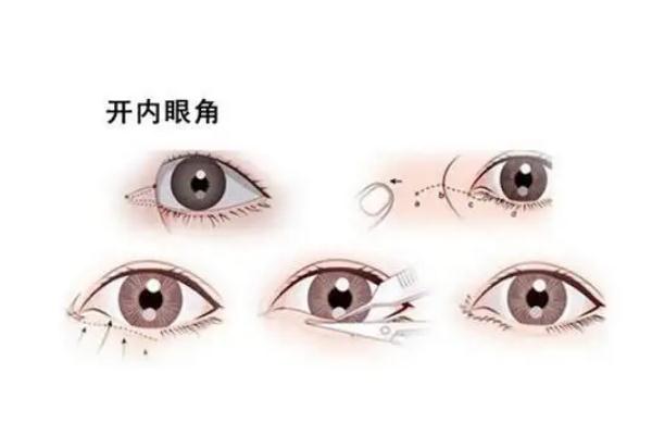 開眼角手術(shù)一般需要多少錢 開眼角手術(shù)危險(xiǎn)嗎 開眼角手術(shù)一般需要多少錢 開眼角手術(shù)危險(xiǎn)嗎