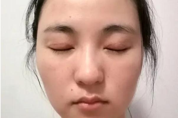 開眼角有必要嗎 開眼角會(huì)長回去嗎