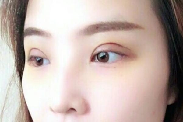 開眼角是啥意思 開眼角是大手術(shù)嗎 開眼角是啥意思 開眼角是大手術(shù)嗎