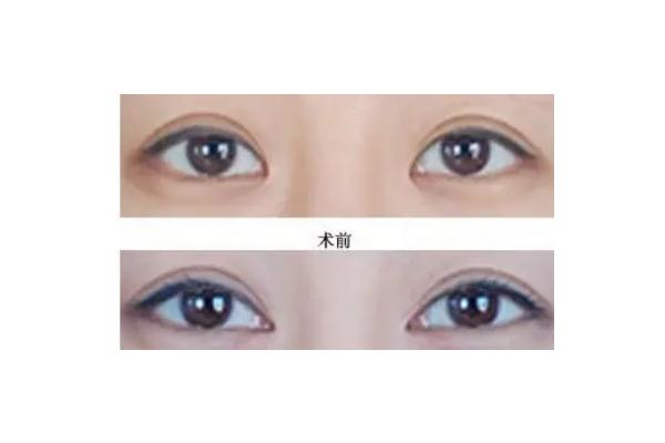 開(kāi)眼角可以修復(fù)原樣嗎 開(kāi)眼角可以做第二次嗎 開(kāi)眼角可以修復(fù)原樣嗎 開(kāi)眼角可以做第二次嗎
