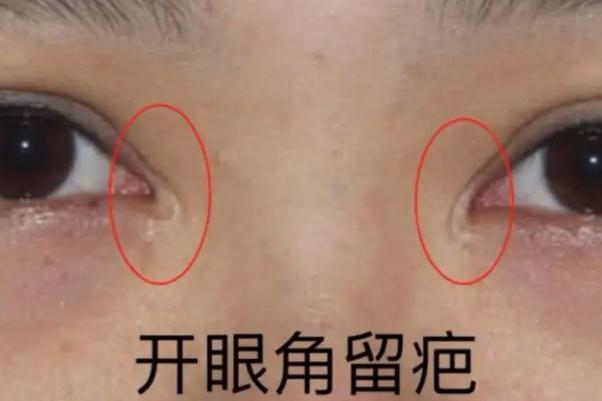 開眼角手術(shù)一般需要多少錢 開眼角手術(shù)危險(xiǎn)嗎 開眼角手術(shù)一般需要多少錢 開眼角手術(shù)危險(xiǎn)嗎