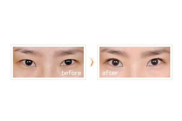 開眼角會(huì)顯老嗎 開眼角對(duì)眼睛有危害嗎 開眼角會(huì)顯老嗎 開眼角對(duì)眼睛有危害嗎