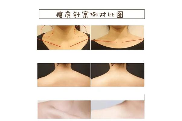 瘦肩針有什么危害和副作用 瘦肩針一針大概多少錢 瘦肩針有什么危害和副作用 瘦肩針一針大概多少錢