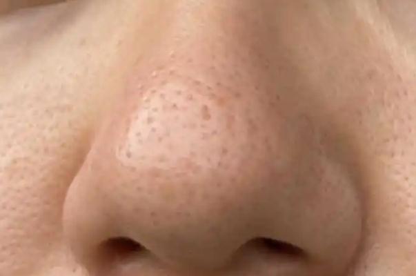 毛孔粗大是缺乏什么維生素 毛孔粗大是什么意思 毛孔粗大是缺乏什么維生素 毛孔粗大是什么意思