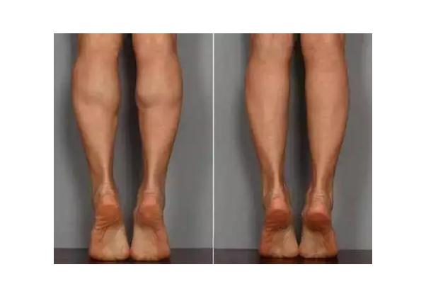 瘦腿針是溶脂針嗎 瘦腿針要一直打嗎 瘦腿針是溶脂針嗎 瘦腿針要一直打嗎