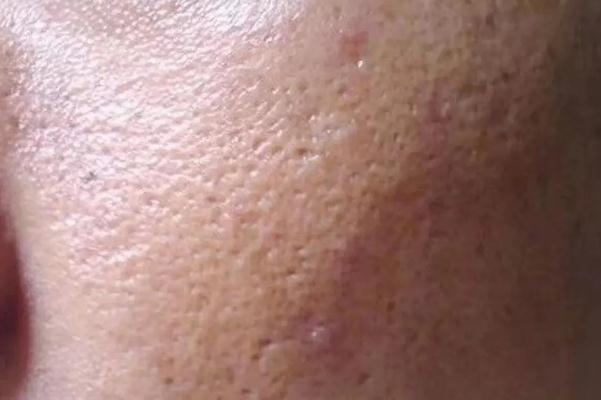 毛孔粗大要補水還是控油 毛孔粗大要不要用洗面奶 毛孔粗大要補水還是控油 毛孔粗大要不要用洗面奶