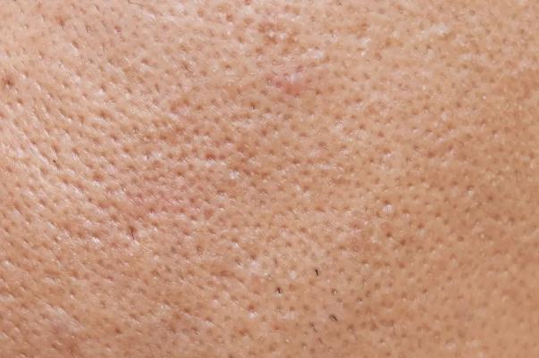 毛孔粗大是永久的嗎 毛孔粗大是缺水嗎 毛孔粗大是永久的嗎 毛孔粗大是缺水嗎