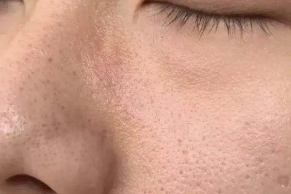 毛孔粗大會自己慢慢變小嗎 毛孔粗大會持續(xù)一輩子嗎 毛孔粗大會自己慢慢變小嗎 毛孔粗大會持續(xù)一輩子嗎