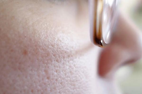 毛孔粗大要補水還是控油 毛孔粗大要不要用洗面奶 毛孔粗大要補水還是控油 毛孔粗大要不要用洗面奶