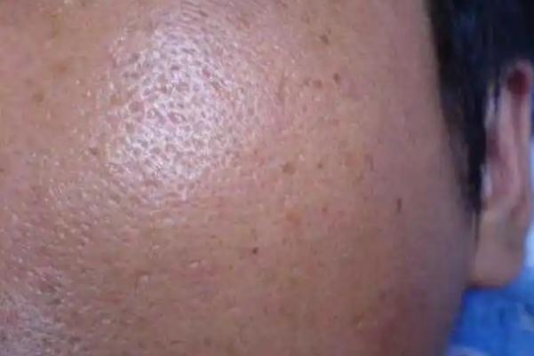 毛孔粗大有色斑怎么改善 毛孔粗大有什么危害 毛孔粗大有色斑怎么改善 毛孔粗大有什么危害