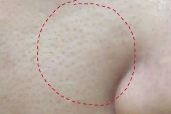 毛孔粗大是永久的嗎 毛孔粗大是缺水嗎 毛孔粗大是永久的嗎 毛孔粗大是缺水嗎