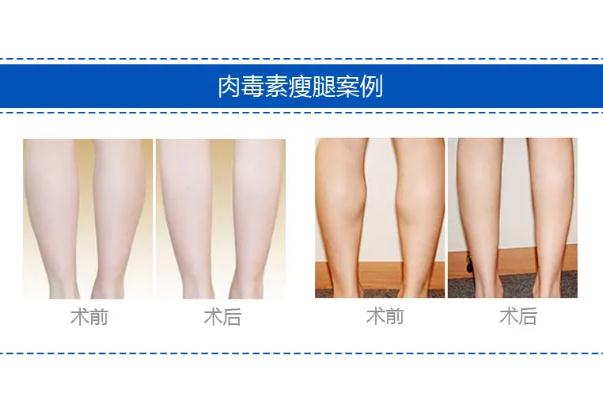 瘦腿針注意事項(xiàng) 瘦腿針打幾次永久定型 瘦腿針注意事項(xiàng) 瘦腿針打幾次永久定型