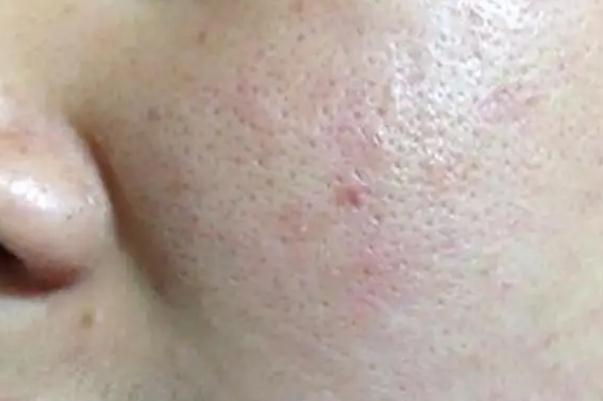 毛孔粗大是永久的嗎 毛孔粗大是缺水嗎 毛孔粗大是永久的嗎 毛孔粗大是缺水嗎