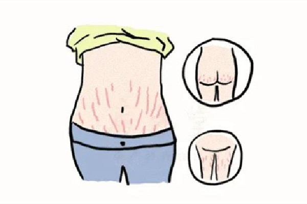 肥胖紋有時(shí)候明顯有時(shí)候不明顯 肥胖紋會一直擴(kuò)散嗎 肥胖紋有時(shí)候明顯有時(shí)候不明顯 肥胖紋會一直擴(kuò)散嗎