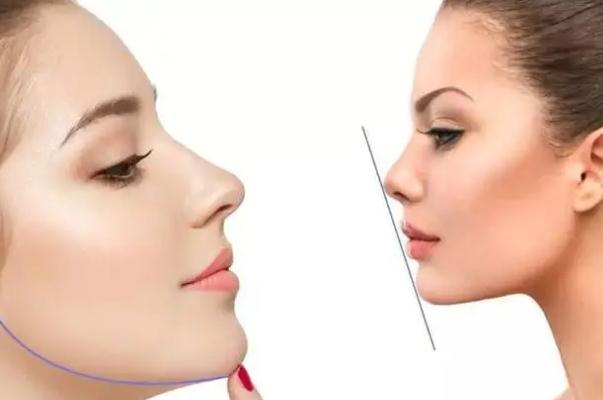 玻尿酸填充下巴的副作用 玻尿酸填充下巴的注意事項 玻尿酸填充下巴的副作用 玻尿酸填充下巴的注意事項