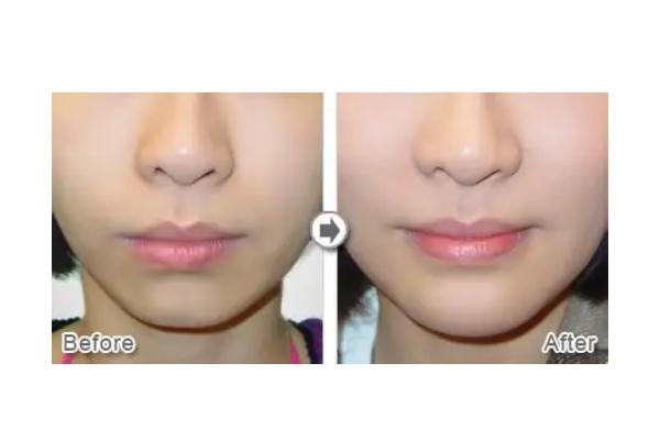 玻尿酸填充下巴是不是越尖越好 玻尿酸填充下巴是怎么形成的 玻尿酸填充下巴是不是越尖越好 玻尿酸填充下巴是怎么形成的