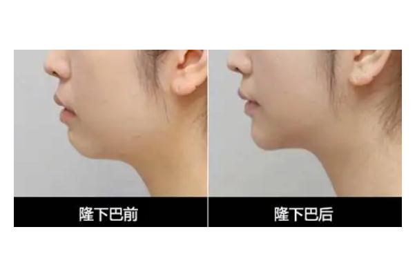 玻尿酸填充下巴的副作用 玻尿酸填充下巴的注意事項 玻尿酸填充下巴的副作用 玻尿酸填充下巴的注意事項