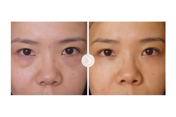 去眼袋手術(shù)會失敗嗎 去眼袋手術(shù)會導(dǎo)致眼失明嗎 去眼袋手術(shù)會失敗嗎 去眼袋手術(shù)會導(dǎo)致眼失明嗎