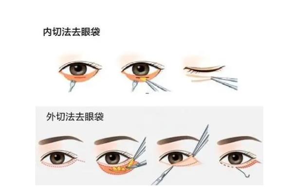 去眼袋手術(shù)費(fèi)用大概多少錢 去眼袋手術(shù)有危害嗎 去眼袋手術(shù)費(fèi)用大概多少錢 去眼袋手術(shù)有危害嗎