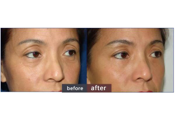 去眼袋手術(shù)會失敗嗎 去眼袋手術(shù)會導(dǎo)致眼失明嗎 去眼袋手術(shù)會失敗嗎 去眼袋手術(shù)會導(dǎo)致眼失明嗎