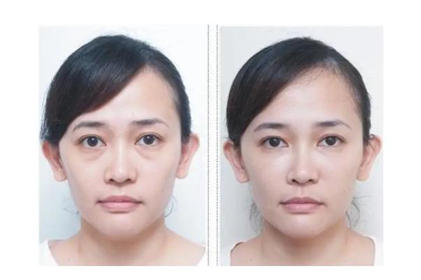 去眼袋手術(shù)是全麻還是局麻 去眼袋手術(shù)是內(nèi)切好還是外切好 去眼袋手術(shù)是全麻還是局麻 去眼袋手術(shù)是內(nèi)切好還是外切好