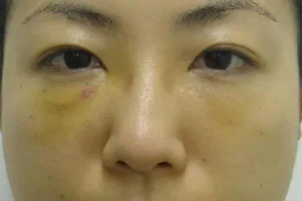 去眼袋手術(shù)要住院?jiǎn)?去眼袋手術(shù)要休息多久 去眼袋手術(shù)要住院?jiǎn)?去眼袋手術(shù)要休息多久