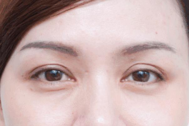 去眼袋手術(shù)會失敗嗎 去眼袋手術(shù)會導(dǎo)致眼失明嗎 去眼袋手術(shù)會失敗嗎 去眼袋手術(shù)會導(dǎo)致眼失明嗎