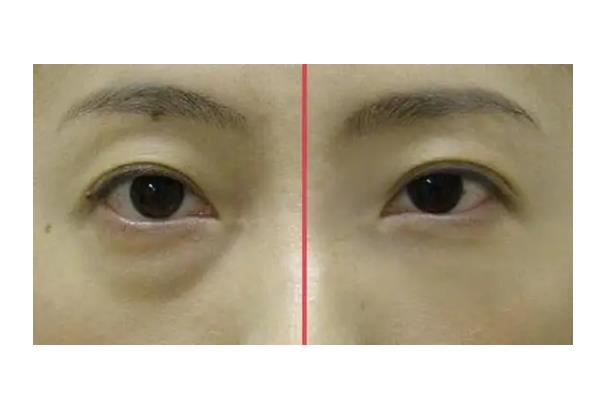 去眼袋手術(shù)有幾種 去眼袋手術(shù)有效果嗎 去眼袋手術(shù)有幾種 去眼袋手術(shù)有效果嗎