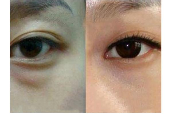 去眼袋手術(shù)費(fèi)用大概多少錢 去眼袋手術(shù)有危害嗎 去眼袋手術(shù)費(fèi)用大概多少錢 去眼袋手術(shù)有危害嗎