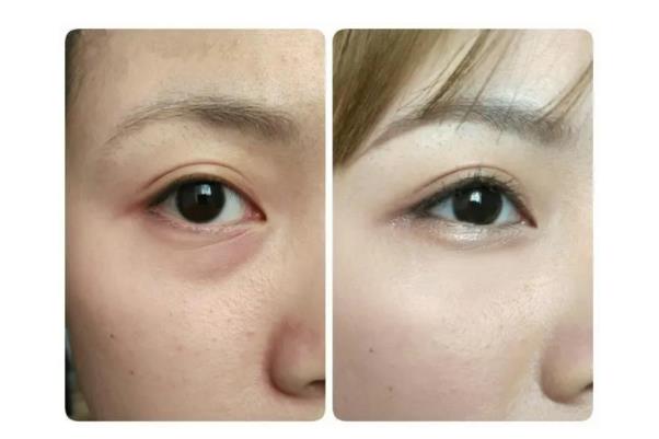 去眼袋手術(shù)要住院?jiǎn)?去眼袋手術(shù)要休息多久 去眼袋手術(shù)要住院?jiǎn)?去眼袋手術(shù)要休息多久