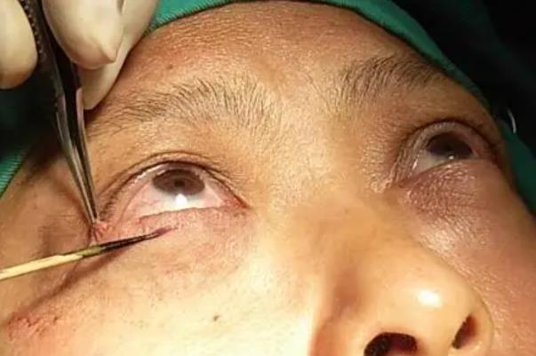 去眼袋手術(shù)費(fèi)用大概多少錢 去眼袋手術(shù)有危害嗎 去眼袋手術(shù)費(fèi)用大概多少錢 去眼袋手術(shù)有危害嗎