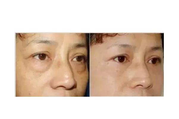 去眼袋手術(shù)會把臥蠶去掉嗎 去眼袋手術(shù)對眼有傷害嗎 去眼袋手術(shù)會把臥蠶去掉嗎 去眼袋手術(shù)對眼有傷害嗎