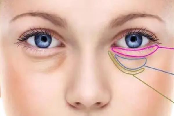 去眼袋手術(shù)要住院?jiǎn)?去眼袋手術(shù)要休息多久 去眼袋手術(shù)要住院?jiǎn)?去眼袋手術(shù)要休息多久