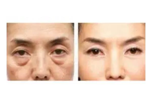 去眼袋手術(shù)會反彈嗎 去眼袋手術(shù)會不會把臥蠶做沒了 去眼袋手術(shù)會反彈嗎 去眼袋手術(shù)會不會把臥蠶做沒了