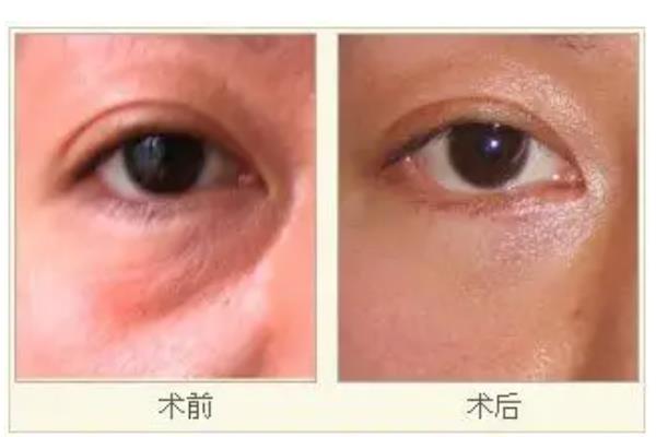 去眼袋手術(shù)有幾種 去眼袋手術(shù)有效果嗎 去眼袋手術(shù)有幾種 去眼袋手術(shù)有效果嗎