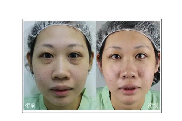 去眼袋手術(shù)會把臥蠶去掉嗎 去眼袋手術(shù)對眼有傷害嗎 去眼袋手術(shù)會把臥蠶去掉嗎 去眼袋手術(shù)對眼有傷害嗎