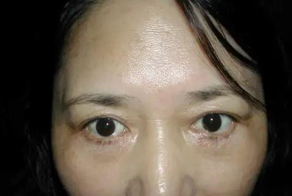 去眼袋手術(shù)可以保持多久 去眼袋手術(shù)可以去除眼睛下面皺紋嗎 去眼袋手術(shù)可以保持多久 去眼袋手術(shù)可以去除眼睛下面皺紋嗎