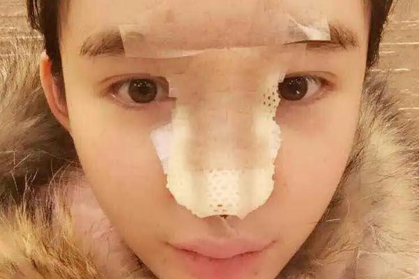 耳軟骨隆鼻有什么后遺癥 耳軟骨隆鼻有點(diǎn)歪可以調(diào)整嗎 耳軟骨隆鼻有什么后遺癥 耳軟骨隆鼻有點(diǎn)歪可以調(diào)整嗎