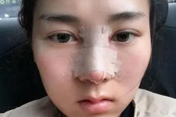 耳軟骨隆鼻會攣縮嗎 耳軟骨隆鼻會變形嗎 耳軟骨隆鼻會攣縮嗎 耳軟骨隆鼻會變形嗎