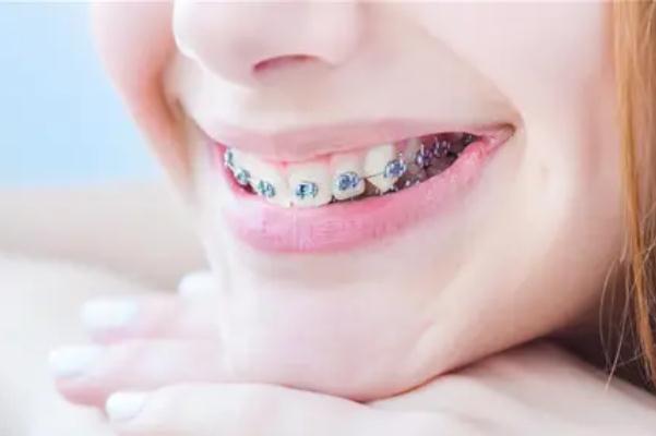 戴牙套痛不痛 戴牙套不能吃什么 戴牙套痛不痛 戴牙套不能吃什么