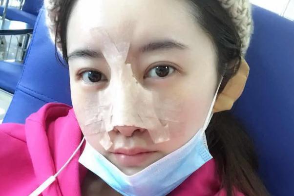 耳軟骨隆鼻是取一側(cè)還是兩側(cè) 耳軟骨隆鼻是用自己的耳軟骨嗎 耳軟骨隆鼻是取一側(cè)還是兩側(cè) 耳軟骨隆鼻是用自己的耳軟骨嗎