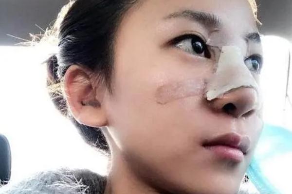 耳軟骨隆鼻有異物感 耳軟骨隆鼻有鼻炎可以做嗎 耳軟骨隆鼻有異物感 耳軟骨隆鼻有鼻炎可以做嗎